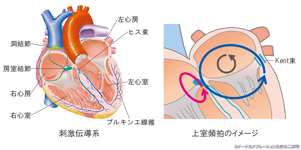 刺激伝導系と上室頻拍のイメージ