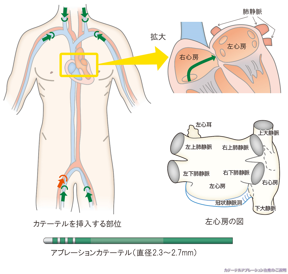 カテーテルアブレーション治療の方法