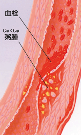 血栓、粥腫（じゅくしゅ）