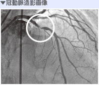 冠動脈造影画像