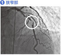 (1) 狭窄部