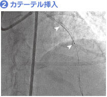 (2) カテーテル挿入