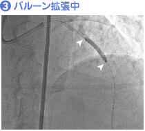 (3) バルーン拡張中