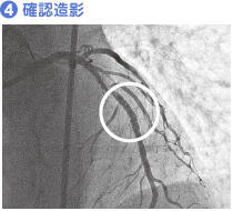 (4) 確認造影