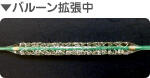 バルーン拡張中