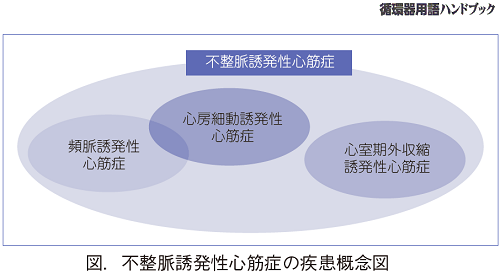 不整脈誘発性心筋症の疾患概念図