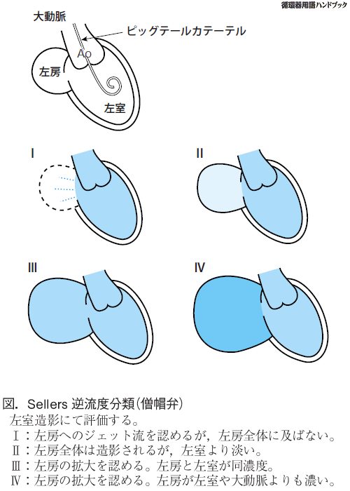 Sellers逆流度分類（僧房弁）