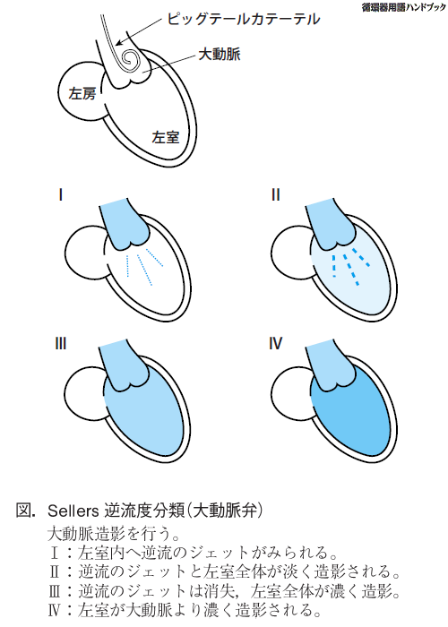 Sellers逆流度分類（大動脈弁）