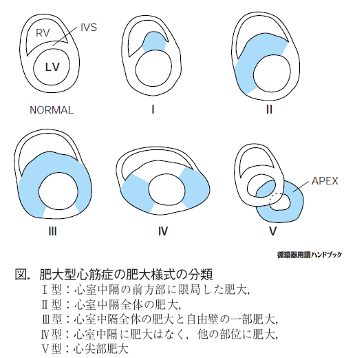 肥大型心筋症の肥大様式の分類