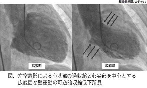 左室造影による心基部の過収縮と心尖部を中心とする広範囲な壁運動の可逆的収縮低下所見