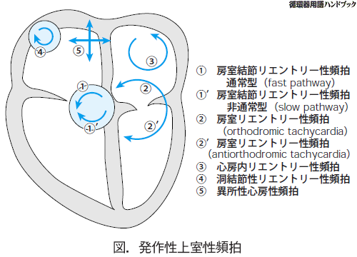 発作性上室性頻拍