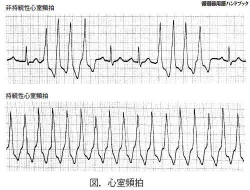 心室頻拍