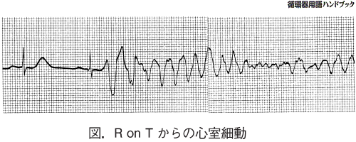 R on Tからの心室細動