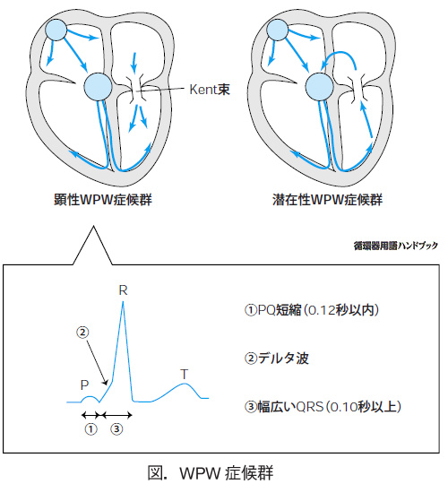 WPW症候群