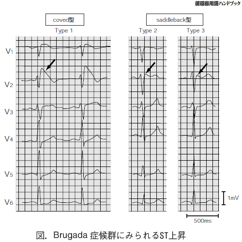 Brugada症候群にみられるST上昇