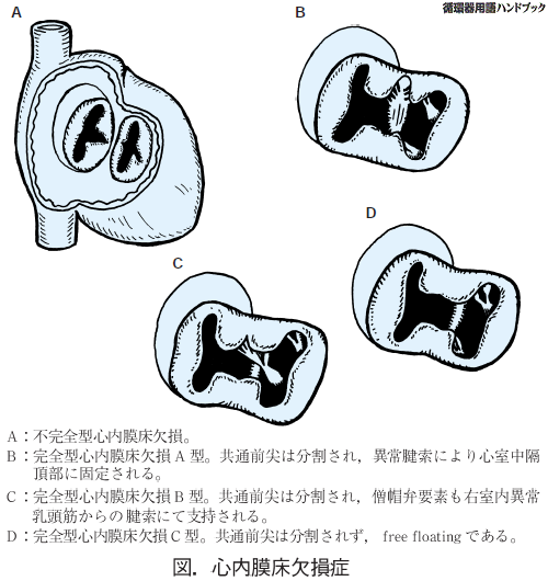 心内膜床欠損症