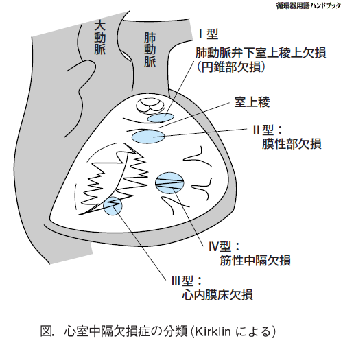 心室中隔欠損症の分類（Kirklinによる）