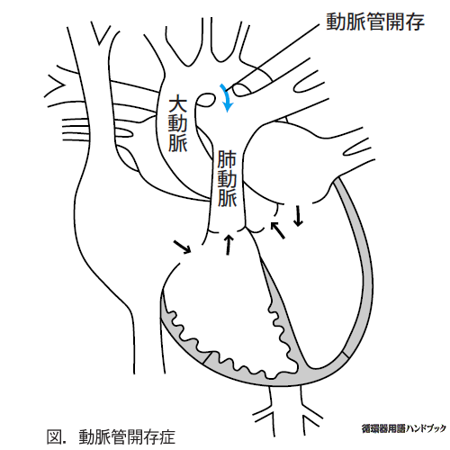 動脈管開存症