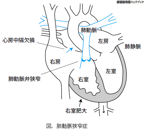 肺動脈狭窄症