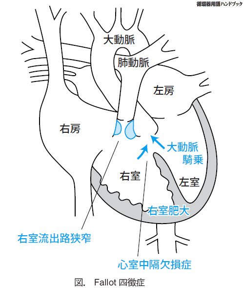 Fallot四徴症