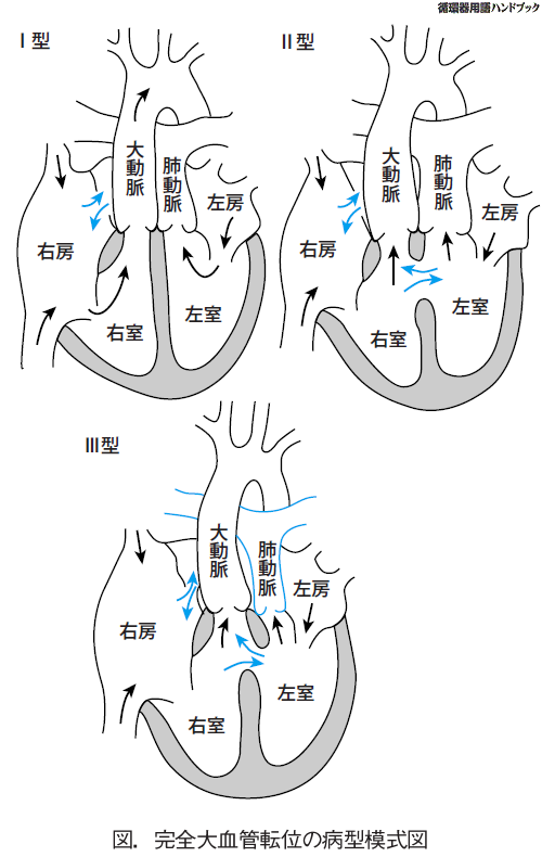 完全大血管転位の病型模式図