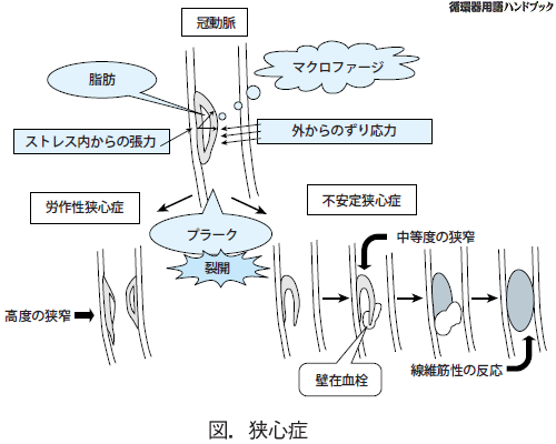 狭心症