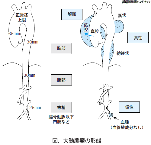 大動脈瘤の形態