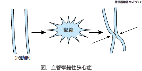 血管攣縮性狭心症