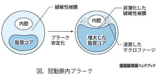 冠動脈内プラーク