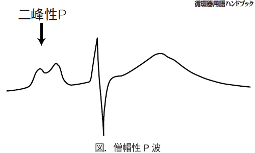 僧帽性P波