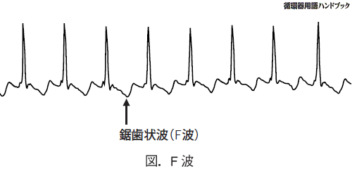 F波