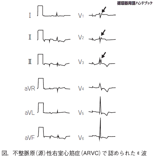 不整脈原（源）性右室心筋症（ARVC）で認められたイプシロン（ε）波