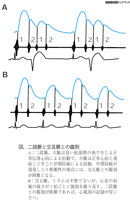 二段脈と交互脈との鑑別
