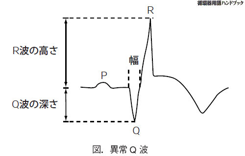 異常Q波