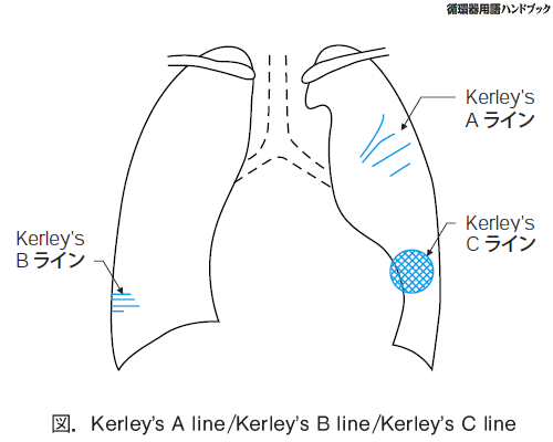 Kerley's A line/Kerley's B line/Kerley's C line