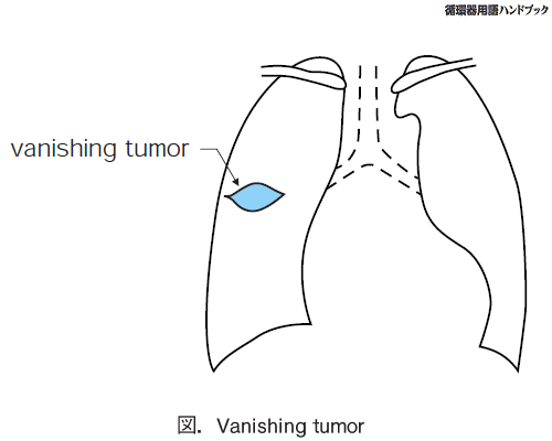 Vanishing tumor