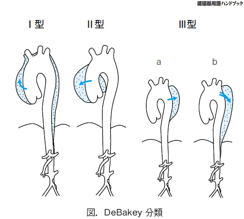 DeBakey分類