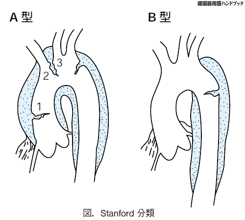 Stanford分類