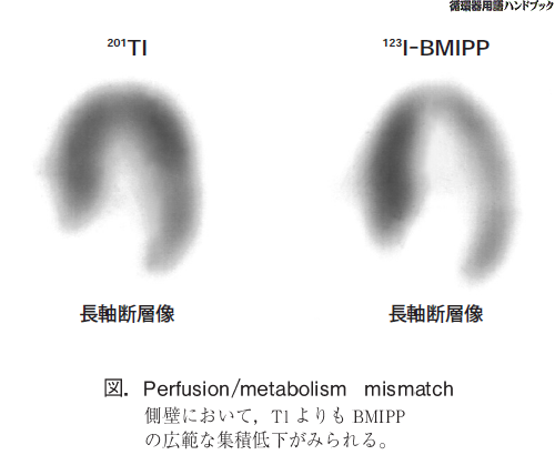Perfuion/metabolism mismatch