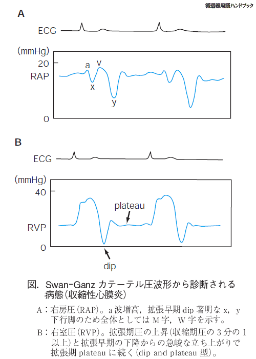 Swan-Ganzカテーテル圧波形から診断される病態（収縮性心膜炎）