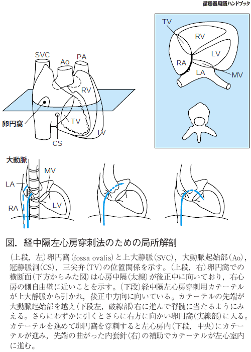 経中隔左心房穿刺のための局所解剖