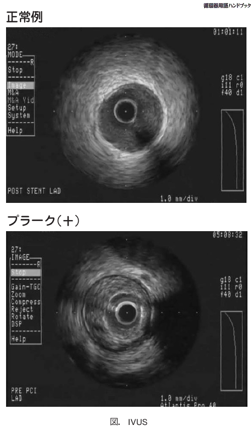 IVUS