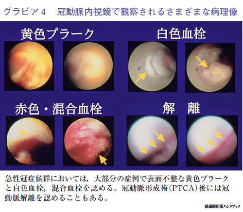 冠動脈内視鏡で観察されるさまざまな病理像