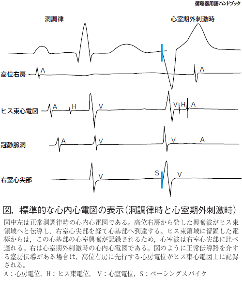 標準的な心内心電図の表示（洞調律時と心室期外刺激時）