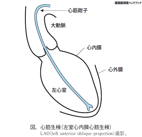 心筋生検（左室心内膜心筋生検）