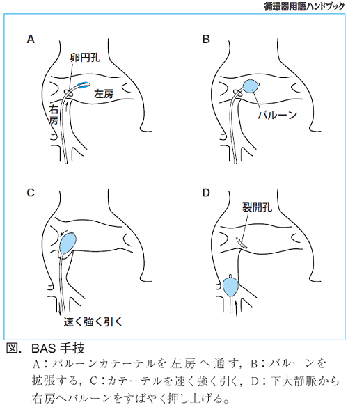 図.BAS手術