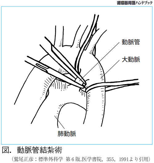 図.動脈管結紮術
