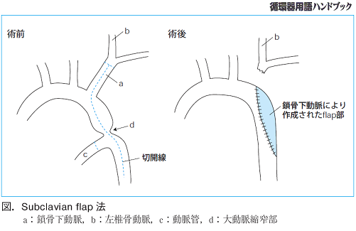 図.subclavian flap法