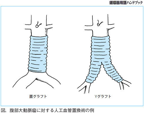 図.腹部大動脈瘤に対する人工血管置換術の例