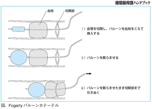 図.Fogartyバルーンカテーテル